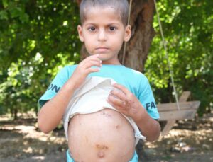 Köpeklerin saldırısına uğrayan çocuk ölümden döndü: 18 gün sonra taburcu oldu